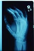 hand xray